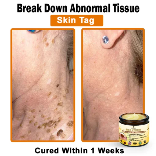 Ourlyard®Bee Venom Multi-Symptom Skin Treatment Cream - Image 2