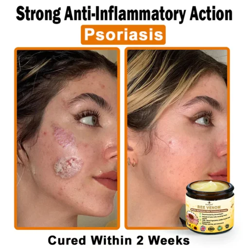 Ourlyard®Bee Venom Multi-Symptom Skin Treatment Cream - Image 4
