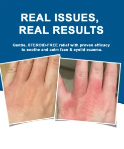 Ourlyard® Skin Treatment Cream