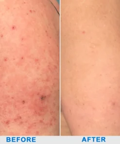Ourlyard® Skin Treatment Cream