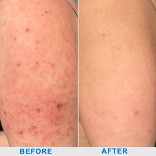 Ourlyard® Skin Treatment Cream