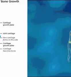 Ourlyard® StaturePro rHGH Microneedle Patch