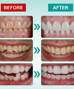 𝗢𝘂𝗿𝗹𝘆𝗮𝗿𝗱® 𝗜𝗻𝘀𝘁𝗮𝗻𝘁 𝗦𝘁𝗶𝗰𝗸-𝗼𝗻 𝗗𝗲𝗻𝘁𝗮𝗹 𝗩𝗲𝗻𝗲𝗲𝗿𝘀