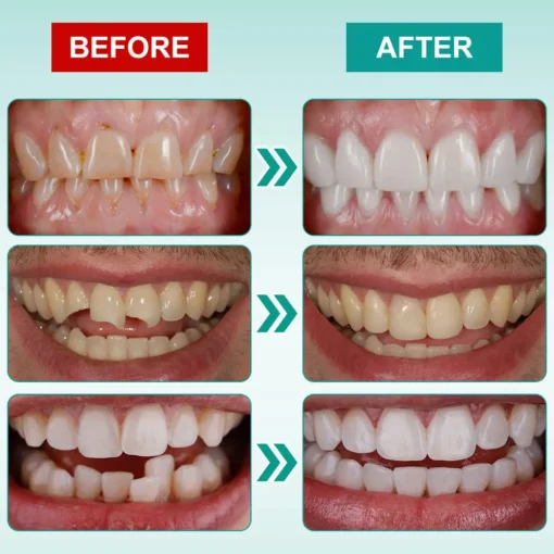 𝗢𝘂𝗿𝗹𝘆𝗮𝗿𝗱® 𝗜𝗻𝘀𝘁𝗮𝗻𝘁 𝗦𝘁𝗶𝗰𝗸-𝗼𝗻 𝗗𝗲𝗻𝘁𝗮𝗹 𝗩𝗲𝗻𝗲𝗲𝗿𝘀