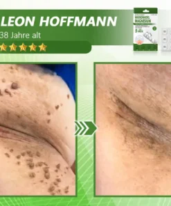 Ourlyard® Magnesium MicroNeedle Schnell Entfernen Hautmal-Pflaster