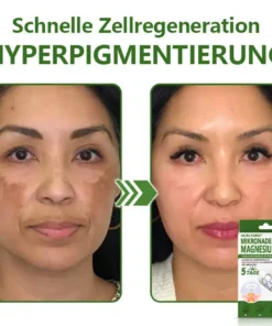 Ourlyard® Magnesium MicroNeedle Schnell Entfernen Hautmal-Pflaster