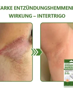 Ourlyard® Magnesium MicroNeedle Schnell Entfernen Hautmal-Pflaster