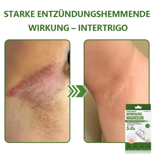 Ourlyard® Magnesium MicroNeedle Schnell Entfernen Hautmal-Pflaster