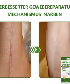 Ourlyard® Magnesium MicroNeedle Schnell Entfernen Hautmal-Pflaster