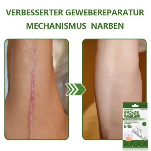Ourlyard® Magnesium MicroNeedle Schnell Entfernen Hautmal-Pflaster
