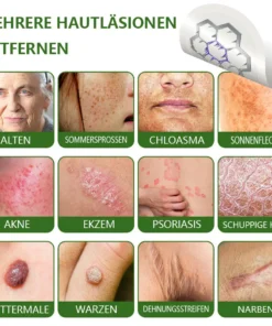 Ourlyard® Magnesium MicroNeedle Schnell Entfernen Hautmal-Pflaster