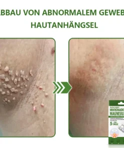 Ourlyard® Magnesium MicroNeedle Schnell Entfernen Hautmal-Pflaster