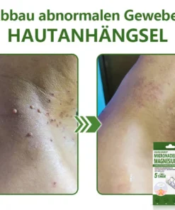 Ourlyard® Magnesium MicroNeedle Schnell Entfernen Hautmal-Pflaster