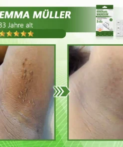 Ourlyard® Magnesium MicroNeedle Schnell Entfernen Hautmal-Pflaster