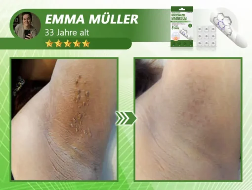 Ourlyard® Magnesium MicroNeedle Schnell Entfernen Hautmal-Pflaster
