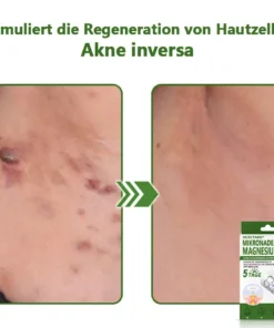 Ourlyard® Magnesium MicroNeedle Schnell Entfernen Hautmal-Pflaster