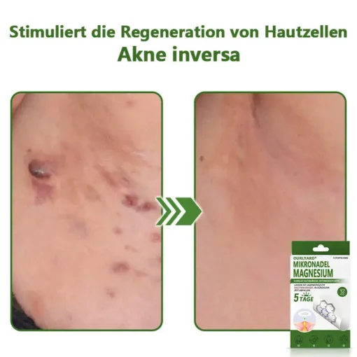 Ourlyard® Magnesium MicroNeedle Schnell Entfernen Hautmal-Pflaster