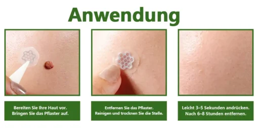 Ourlyard® Magnesium MicroNeedle Schnell Entfernen Hautmal-Pflaster