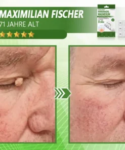 Ourlyard® Magnesium MicroNeedle Schnell Entfernen Hautmal-Pflaster