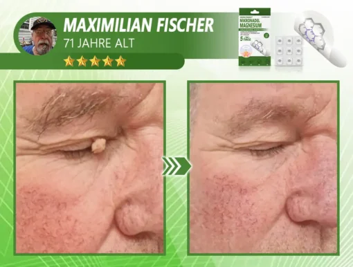 Ourlyard® Magnesium MicroNeedle Schnell Entfernen Hautmal-Pflaster