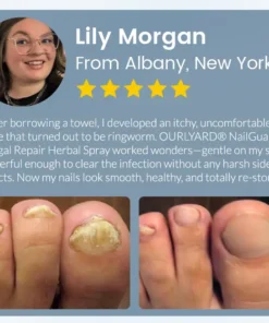 Ourlyard® NailGuard Fungal Repair Herbal Spray